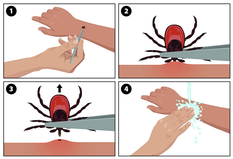 tick-borne illnesses